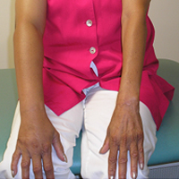 lymphoedema arm swelling